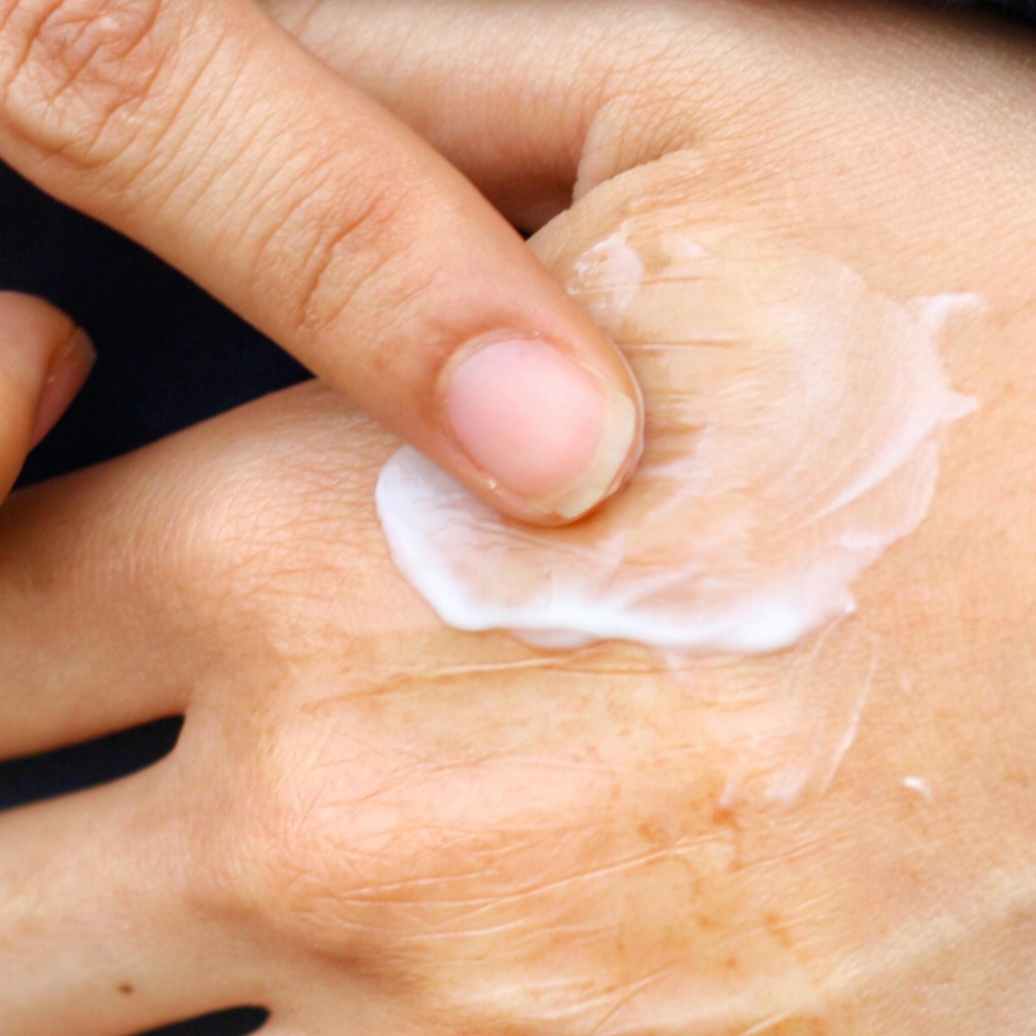 Crema cicatriz queloide